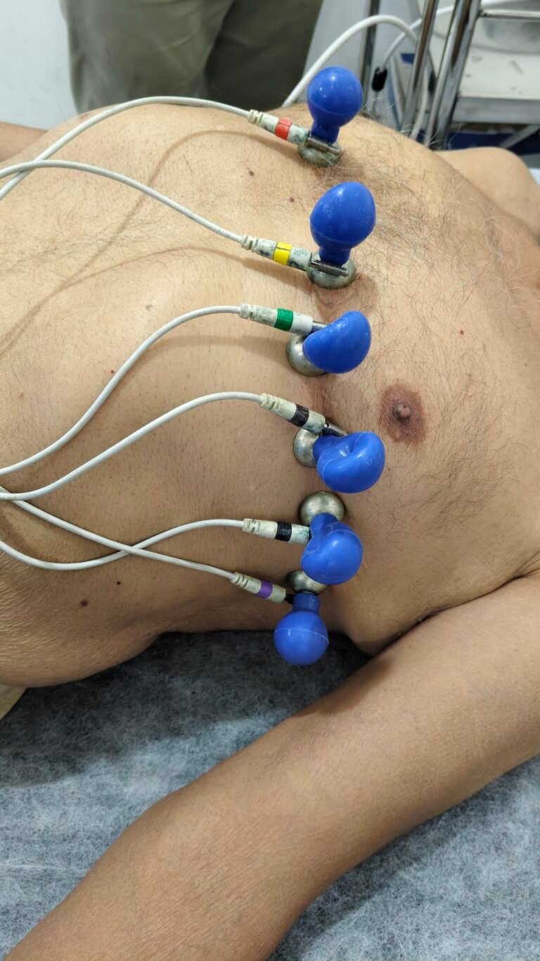 Eletrodos posicionados no tórax para realização de eletrocardiograma